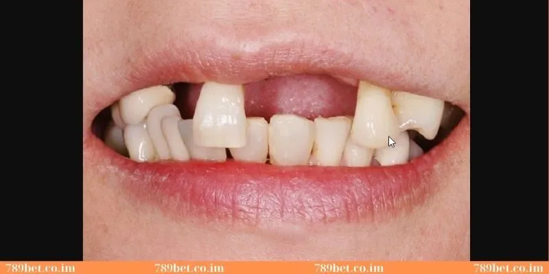 Ý nghĩa của giấc mơ thấy mình gãy răng